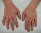 Lichen Simplex Chronicus Treatment Mayo Clinic Pictures