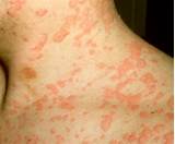 Images of Allergic Reaction Acne Treatment