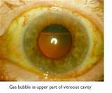 Retinal Detachment Surgery Gas Bubble Photos