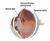 Pictures of Silicone Oil Removal Eye Surgery Recovery Time
