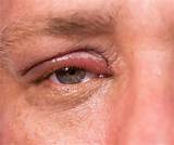 Pictures of Herpes Around The Eye Treatment