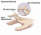 Hyperextended Thumb Treatment Images