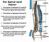 Spinal Cord Injury Treatment Options Photos