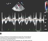 Clinical Manual And Review Of Transesophageal Echocardiography Pictures