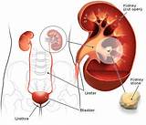 Pictures of Kidney Stone Removal Medical Term