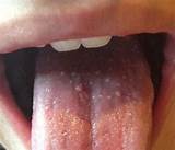 Photos of Pimple On Tongue Treatment