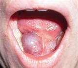 Pimple On Tongue Treatment Photos