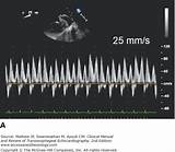 Clinical Manual And Review Of Transesophageal Echocardiography