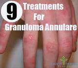 Photos of Granuloma Annulare Home Remedies