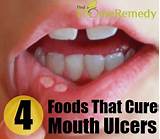 Raw Tongue Home Remedies Images