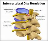Photos of Cervical Spine Disc Bulge Treatment