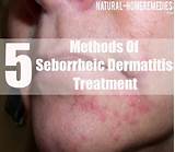 Seborrheic Eczema Home Remedies Pictures
