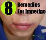 Photos of Impetigo Treatment Home Remedies