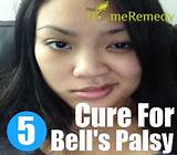 First Signs Of Recovery From Bell''s Palsy Images