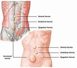 Images of Where Can Hernias Occur