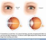 Pictures of Cataract And Glaucoma Surgery Recovery Time