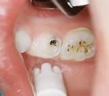 Images of Silver Treatment For Cavities
