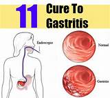 Gastric Problem Symptoms Treatment Pictures