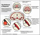 Severe Migraine Headache Treatment
