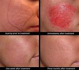 Scarlet Treatment Side Effects Images