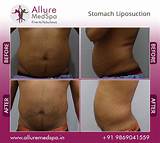 Belly Fat Laser Treatment Cost Photos