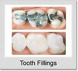 Pictures of Dental Implants Denton