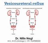 Vesicoureteral Reflux Treatment