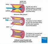 Images of Angioplasty Recovery Time