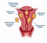 Ablation Uterus Recovery Pictures