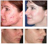 Laser Treatment For Skin Pigmentation Side Effects