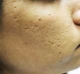 Images of Treatments For Ice Pick Acne Scars