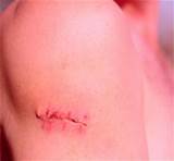 Lipoma Surgery Recovery Images