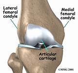 Osteochondral Defect Medial Femoral Condyle Treatment Pictures