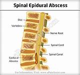 Spinal Cord Abscess Treatment Pictures