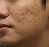 Laser Treatment For Pimple Scars Photos