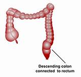 Sigmoid Colon Removal Recovery Pictures