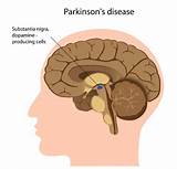 Images of Parkinson''s Disease Symptoms Mayo Clinic