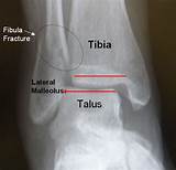 Photos of Orif Tibia Recovery Time
