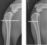 Canine Acl Tear Non Surgical Treatment Pictures