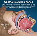 Severe Obstructive Sleep Apnea Treatment