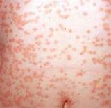 Images of Guttate Psoriasis Home Remedies