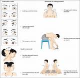 Balance Exercises Labyrinthitis Images