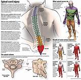 Spinal Cord Injury Treatment Options Images