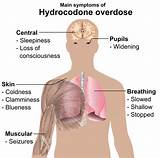 What Are The Side Effects Of Hydrocodone Images
