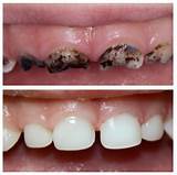 Images of Silver Nitrate In Dentistry