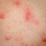 Photos of Can Stress Cause Hives