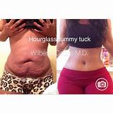 Recovery After Tummy Tuck And Lipo Pictures