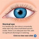 Pictures of Medical Word For Pink Eye