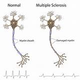 Ms Stem Cell Treatment Chicago Photos