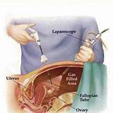 What Is The Recovery Time For A Total Hysterectomy